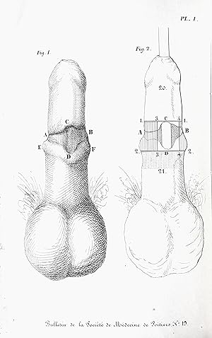 Thécoplastie de l'urètre. (Extrait du Bulletin n° 19 de la Société de médecine de Poitiers.)
