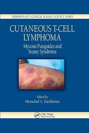 Immagine del venditore per Cutaneous T-Cell Lymphoma : Mycosis Fungoides and Sezary Syndrome venduto da AHA-BUCH GmbH