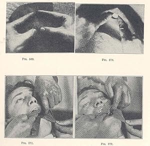 Seller image for A work on operative dentistry : in two volumes [The pathology of the hard tissues of the teeth. The technical procedures in filling teeth. Treatment of dental caries. Technical procedures in making restorations in the teeth.] for sale by Joseph Valles - Books