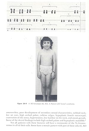 Image du vendeur pour Clinical pedodontics. [The children's dentisthis practice & his community ; Parent counseling & child behavior-- Child management in the dental office; Morphology of the primary teeth; Diagnosis & treatment planning for the child patient; Roentgenography; The problem of pain & sedation; Operative dentistry for children; Properties & uses of restorative materials; Pulpal treatment of primary teeth; The care of injuries to the anterior teeth of children; Removable partial dentures for children; Periodontal diseases in children; Face development & tooth eruption-- Preliminary steps in preventive orthodontics; Preventive orthodontics; Oral habits in children; Oral surgery for children; Antimicrobial agents; Epidemiology of dental caries; etc] mis en vente par Joseph Valles - Books