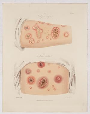 Ecthyma vulgare; Ecthyma luridum.