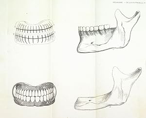 De la gutta-percha et de son application aux dentures artificielles en remplacement des plaques m...