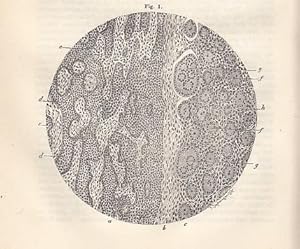 Bild des Verkufers fr Ueber eine eigenthmliche Form des Ovarialcarcinoms. IN: Centralbl. f. Allgemeine Pathologie u. Pathol. Anatomie Bd. VI., Nr. 7, S. 257 -264, 1895, Br. zum Verkauf von Antiquariat Michael Eschmann