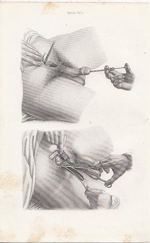 Operationen an den Harnorganen. Blasenschnitt - Cystotomia. 3 x Original - Stahlstiche von Greb, ...