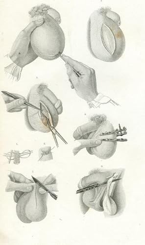 Operation - Hydrocele, Varicocele, Kastration. Stahlstich von Greb, 1860, 23,7 cm x 15,7 cm.