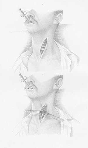 Bild des Verkufers fr Operation des Schlundschnittes - Oesophagotomia. Original - Stahlstich von Greb, 1860, 23,7 cm x 15,7 cm. zum Verkauf von Antiquariat Michael Eschmann