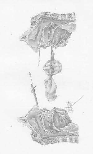 Bild des Verkufers fr Operationen in der Nasenhhle. Original - Stahlstich von Greb, 1860, 23,7 cm x 15,7 cm. zum Verkauf von Antiquariat Michael Eschmann