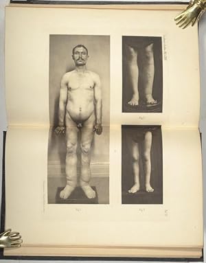 Bild des Verkufers fr Vier Flle von Elephantiasis congenita hereditaria (pp.189-196, 5 photographischen Tafeln auf 2 Photogravuretafeln). zum Verkauf von Antiq. F.-D. Shn - Medicusbooks.Com