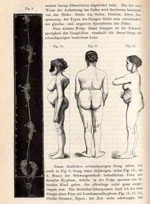 Bild des Verkufers fr Einige Worte ber die sematologische und diagnostische Bedeutung der menschlichen Gangspuren oder Ichnogramme. zum Verkauf von Antiq. F.-D. Shn - Medicusbooks.Com