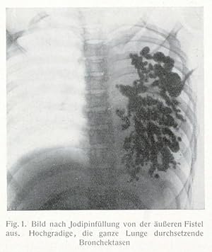 Bild des Verkufers fr Exstirpation eines ganzen Lungenflgels (pp.3003-3006, 4 Abb.). zum Verkauf von Antiq. F.-D. Shn - Medicusbooks.Com