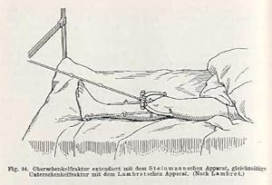 Die Nagelextension der Knochenbrüche. Mit einem Vorwort von C. Garrè.