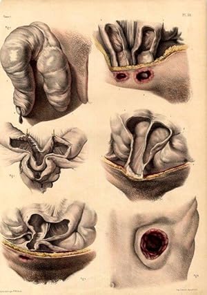 Bild des Verkufers fr Cas varis d'anus contre nauture accidentels. zum Verkauf von Antiq. F.-D. Shn - Medicusbooks.Com