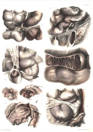 Bild des Verkufers fr Cas varis d'tranglemens intestinaux. 1 Tafel nach Zeichnungen von N.H.Jacobs. zum Verkauf von Antiq. F.-D. Shn - Medicusbooks.Com