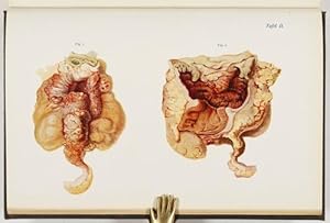 Bild des Verkufers fr Tuberkulose, Aktinomykose, Syphilis des Magen-Darmkanals. zum Verkauf von Antiq. F.-D. Shn - Medicusbooks.Com