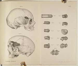 Ueber Schussverletzungen mit dem Deutschen Armeerevolver 83. (pp.120-138, 1 lith. Doppeltafel mit...