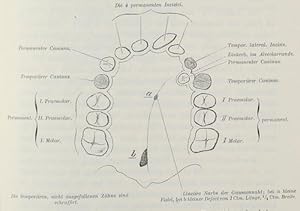 Imagen del vendedor de Die Hasenscharten der Heidelberger Klinik, 1877-1883. Mit besonderer Ber�cksichtigung der Mortalit�tsstatistik und einem Beitrag zur Odontologie (pp.355-402, Holzschnitte). a la venta por Antiq. F.-D. S�hn - Medicusbooks.Com