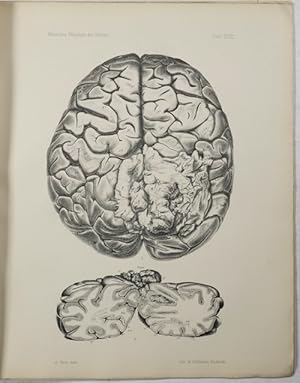 Bild des Verkufers fr 3. Teil: Klinische und anatomische Beitrge zur Pathologie des Gehirns. 1. + 2. Hlfte. zum Verkauf von Antiq. F.-D. Shn - Medicusbooks.Com