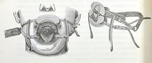 Ueber Zungenamputation mittelst des Thermocauters (pp.162-179, mit Holzschnitten).