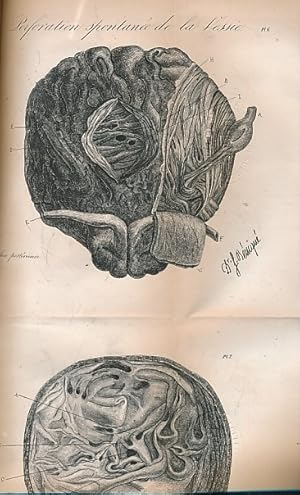 Seller image for De La Rtention D'Urine et D'Une Nouvelle Mthode pour Introduire Les Bougies et Les Sondes Dans La Vessie.[I] Recherches sur La Nature et Le Traitement D'Une Cause Frquente et Peu Connue de Rtention D'Urine. [II]. 2 books in one volume for sale by Barter Books Ltd