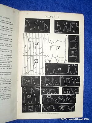 Bild des Verkufers fr On the Interpretation of Cardiographic Tracings and Evidence Causation of Murmurs Attendant Upon Mitral Stenosis. from Guy's Hospital Reports, 1875, Third Series, Vol XX, zum Verkauf von Tony Hutchinson