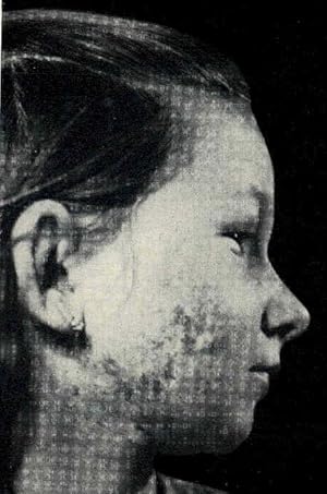 Imagen del vendedor de The plastic surgery atlas. [Definition and purpose of plastic surgery -- Surgery -- Skin transfer -- Tissue grafts as material for reconstruction -- Granulating wounds and ulcers -- Scars -- Tumours -- Vol.2 Head -- Skull -- Face -- Hare lip and cleft palate (usual forms) -- Rare malformations of cleft character -- Lip and mouth -- Chin and mandible -- Eyelids and orbit -- Nose -- Auricles] a la venta por Joseph Valles - Books