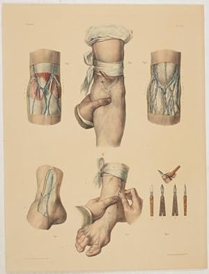 Bild des Verkufers fr Phlbotomie. Saignes du Bras et du Pied. 1 Tafel mit 6 Abbildungen nach Zeichnungen von N.H.Jacob. zum Verkauf von Antiq. F.-D. Shn - Medicusbooks.Com