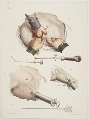 Bild des Verkufers fr Mthode de Ponction Sous-Cuatane de M.J. Gurin. 1 Tafel nach Zeichnungen von Nh.Jacob. zum Verkauf von Antiq. F.-D. Shn - Medicusbooks.Com