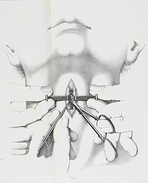 Faits cliniques de laryngotomie.