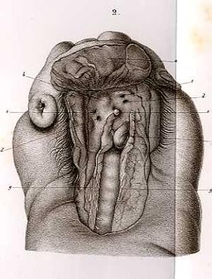 Bild des Verkufers fr Beschreibung einer Missgeburt mit vollstndiger Wirbelspalte und einem Darmbruche in der Rckgratshhle (pp.22-33). zum Verkauf von Antiq. F.-D. Shn - Medicusbooks.Com