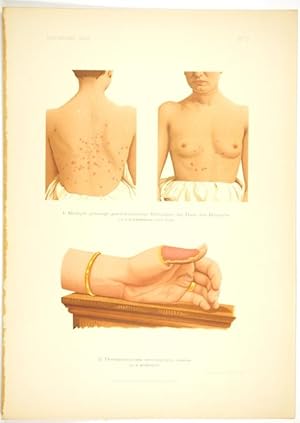 Immagine del venditore per Multiple benigne, geschwulstartige Bildungen der Haut. + Mansourouff, N.: Un cas de dermatomycose circonscrite de la main (Inosis dermica.). venduto da Antiq. F.-D. Shn - Medicusbooks.Com