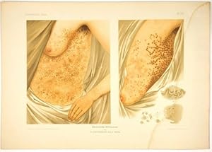 Immagine del venditore per Zwei Flle von Darier'scher Dermatose. venduto da Antiq. F.-D. Shn - Medicusbooks.Com