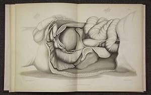 A SHORT TREATISE ON THE SECTION OF THE PROSTATE GLAND IN LITHOTOMY; With an Explanation of a Safe...