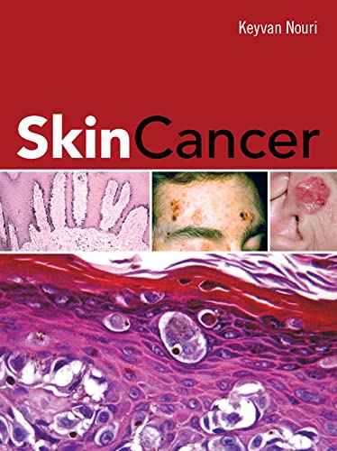 Imagen de archivo de Skin Cancer a la venta por Better World Books