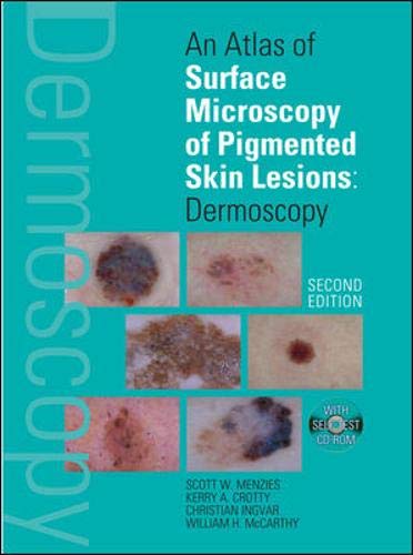 Stock image for An Atlas of Surface Microscopy of Pigmented Skin Lesions: Dermoscopy, Second Edition for sale by NEWBOOKSHOP