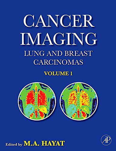 Beispielbild fr Cancer Imaging : Lung and Breast Carcinomas zum Verkauf von Better World Books Ltd