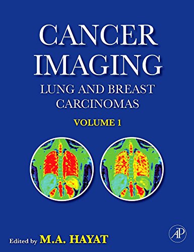 9780123704689: Cancer Imaging,: Lung and Breast Carcinomas: v. 1