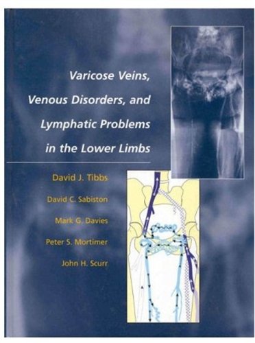 Varicose Veins, Venous Disorders, and Lymphatic Problems in the Lower Limbs (9780192627629) by Tibbs, David; Sabiston, David; Davis, Mark; Mortimer, Peter; Scurr, John