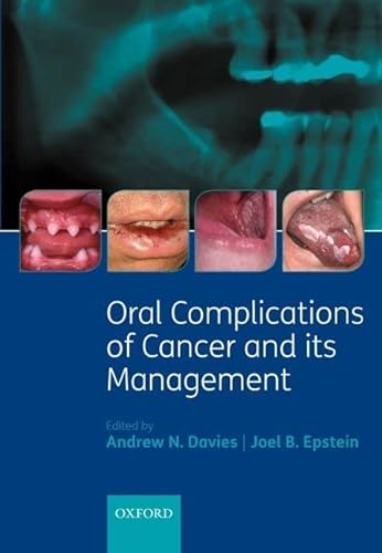 Oral Complications of Cancer and its Management (9780199543588) by Davies, Andrew; Epstein, Joel