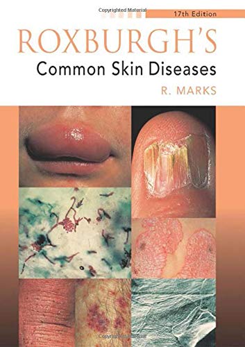 Beispielbild fr Roxburgh's Common Skin Diseases, 17Ed zum Verkauf von WorldofBooks