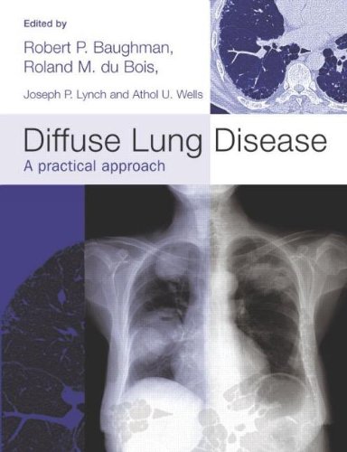 Beispielbild fr Diffuse Lung Disease A practical approach (Hodder Arnold Publication) zum Verkauf von Allyouneedisbooks Ltd