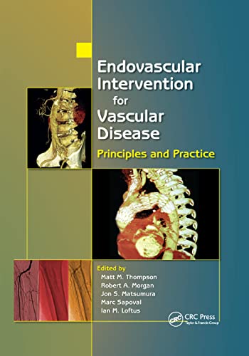 Stock image for Endovascular Intervention for Vascular Disease: Principles and Practice for sale by Blackwell's