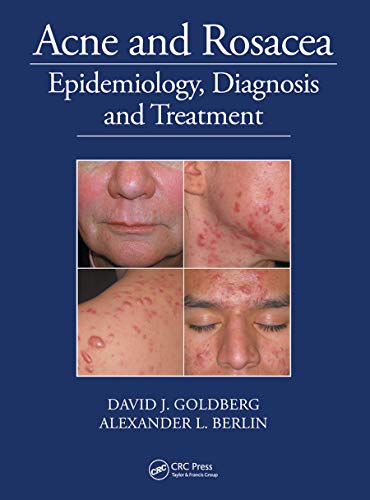 Stock image for Acne and Rosacea: Epidemiology, Diagnosis and Treatment for sale by Revaluation Books