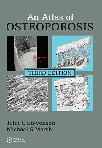 Stock image for An Atlas of Osteoporosis for sale by Ria Christie Collections