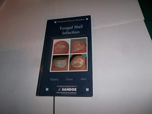 Stock image for POCKET PICTURE GUIDES : FUNGAL NAIL INFECTION for sale by WorldofBooks