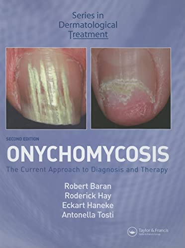Imagen de archivo de Onychomycosis: The Current Approach to Diagnosis and Therapy (Series in Dermatological Treatment) a la venta por Phatpocket Limited