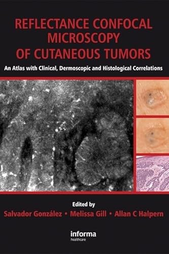 Stock image for Reflectance Confocal Microscopy of Cutaneous Tumors: an Atlas With Clinical, Dermoscopic and Histological Correlations for sale by Lost Books