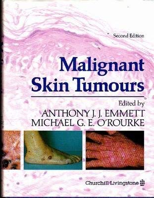 Stock image for Malignant Skin Tumours for sale by Discover Books