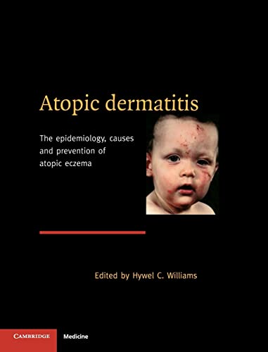 Stock image for Atopic Dermatitis: The Epidemiology, Causes and Prevention of Atopic Eczema for sale by AwesomeBooks