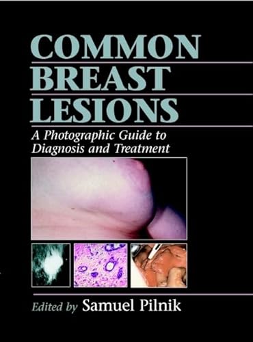 Imagen de archivo de Common Breast Lesions: A Photographic Guide to Diagnosis and Treatment a la venta por Revaluation Books