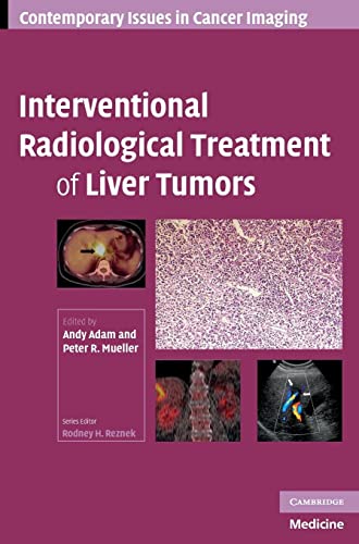 Beispielbild fr Interventional Radiological Treatment of Liver Tumors (Contemporary Issues in Cancer Imaging) zum Verkauf von AwesomeBooks